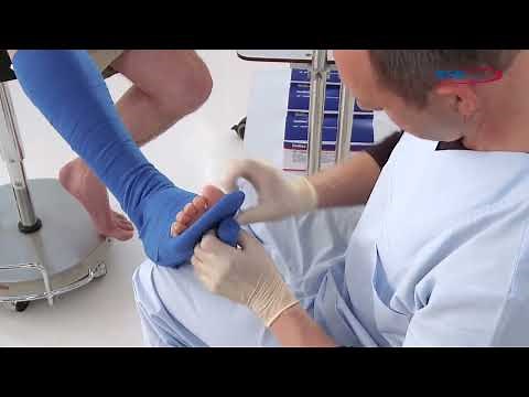 Application of a brace: Reinforced posterior leg brace (butterfly) with Dynacast Prelude