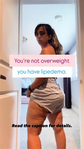 👉I reduced my lipedema appearance by switching to a ketogenic lifestyle. Keto helped me lose weight and reduce inflammation. I’ve been doing strength and rebounder workouts for 3 years. Consistency made the biggest difference. Small, consistent steps create real change. You’re not alone on this journey. 👉Tag a friend who needs to hear this today. #lipodema #weightlossstruggle