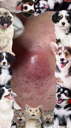 My god!!!😱💕#pimple #cyst #blackhead #USblackhead #cystpopping #fyp