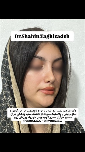 ‎دکتر شاهین تقی‌زاده‎ | ‎نتایج جراحی زیبایی بینی خانم جوان شش ماه بعد از جراحی 🌹👌🎉 @dr.shahin.taghizadeh جهت تعیین نوبت مشاوره با شماره زیر از طریق واتس اپ هماهنگ...‎ | Instagram