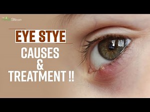 Eye Stye |Causes |Treatment | Symptoms || The Health Site