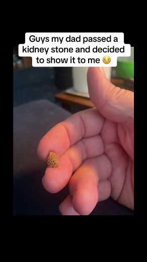 Dealing with Kidney Stones: A Personal Experience