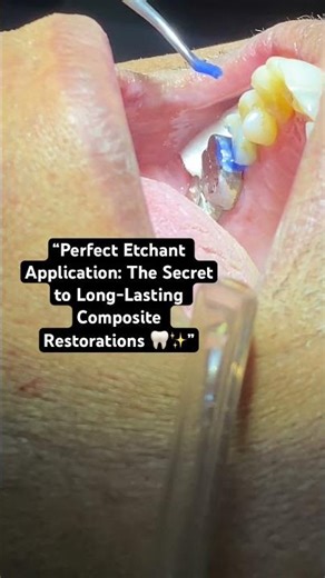 Master the Most Important Step in Composite Restoration 💙”#viral#shorts #reels