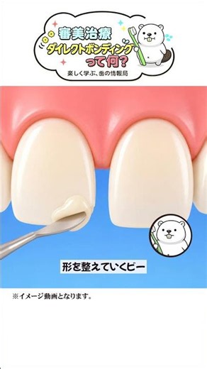 歯が欠けたらどう治すの？ダイレクトボンディングの過程を見ていくビー！