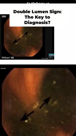 How can Meckel's diverticulum be accurately diagnosed? Capsule endoscopy can identify it via the double lumen sign. • Enteroscopy offers greater diagnostic ease due to the ability to maneuver the scope. • Histologic samples reveal intestinal and gastric tissue presence. • Erosion debris indicates prior bleeding. Watch the full lecture and explore our complete course library at EndoCollab.com. #gastroenterology #gastroenterologia #endoscopy #endoscopia #meckelsdiverticulum | EndoCollab