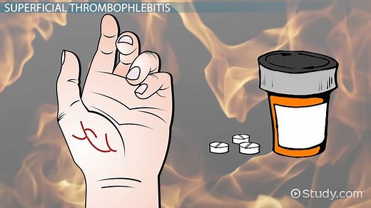 Causes of Blood Clots in the Hand