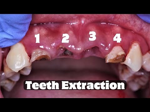 Extraction Of 4 Front Teeth At Once | Pencabutan Gigi | Dentist | Dokter Gigi Tri Putra