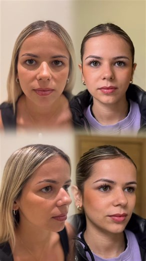 Dra Bruzual Blefaroplastia Sevilla on Instagram: "Antes y después de blefaroplastia a los 26 años ¿Te dicen que pareces cansada incluso durmiendo bien? No siempre el cansancio viene por la edad. A veces viene de la genética. Esta paciente presentaba párpados pesados, algo heredado que le daba una mirada apagada, aunque se sintiera llena de energía. “Siempre me decían que parecía cansada”. Resultados reales, naturales y personalizados Hoy su mirada refleja cómo realmente es. Más abierta, fresca y