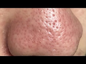 how to get rid of open pores on face for oily skin easy