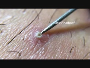 無駄に高画質なニキビ潰し！