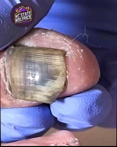 Best Nail Practices for Overgrown Toenails To Avoid Complications #ThickToenailCare #SafeNailCare #NailFixTips #ToenailSupport | NC State Wolfpack on TheWolfpacker.com