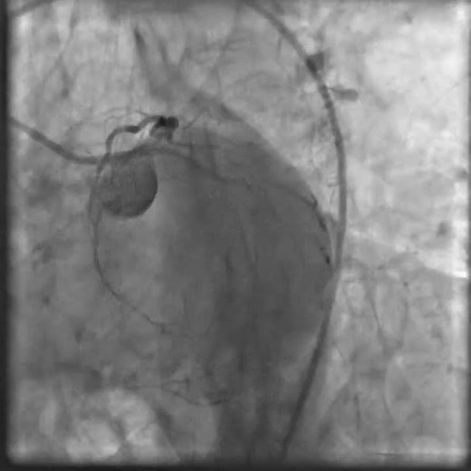Coronary angiography cardiac catheterization video