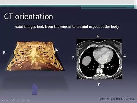 Cardiac CT anatomy