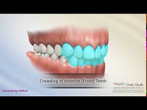 Class I Malocclusion