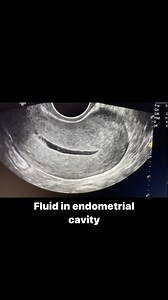 55K views · 968 reactions | Uterus ultrasound #pid #ultrasoundmadeeasy #radiologist #pelvicultrasound | Ultrasound made easy | Facebook