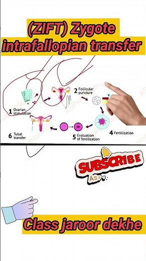 ZIFT (Zygote Intrafallopian Transfer) | Fertilization Technique | Reproduction Chapter in Hindi |