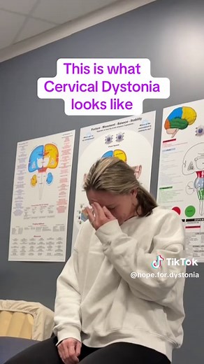 Understanding Cervical Dystonia and Its Challenges