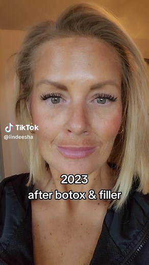 Botox & Filler Transformation: Before & After Results