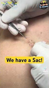 Complete Cyst Incision & Drainage Video 💉🔪 with Dr. H.L. Greenberg at Las Vegas Dermatology®