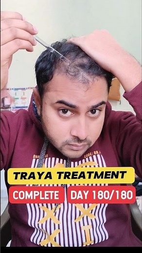 Day 180/180 Traya Treatment Complete | Traya Hair Review