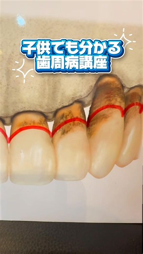 世界一分かりやすい歯周病講座#歯磨き#歯周病#世界一