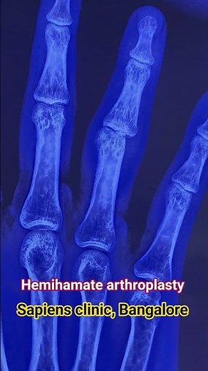 Hemihamate arthroplasty #fingerfracture