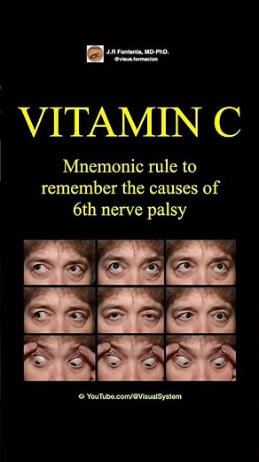 Sixth cranial nerve palsy. VITAMIN C, Mnemonic rule to remember the causes of 6th nerve palsy.