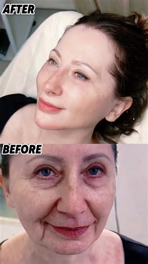 Small-cut lift that refreshes your face without big surgery or threads. #MiniLift #facelift