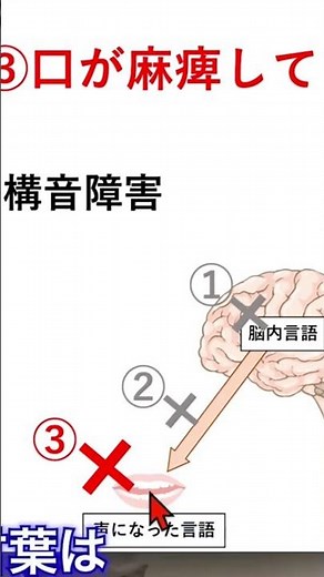 「構音障害」って何？ #失語症 #リハビリ #脳卒中