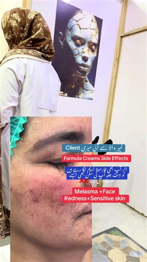 Understanding Formula Creams and Their Side Effects