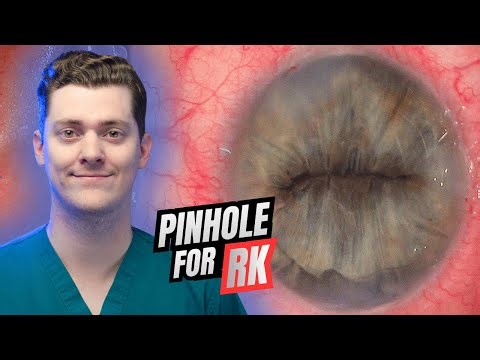 Pinhole Pupilloplasty Basics for RK