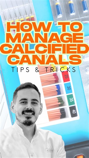 🌟How To Manage Calcified Canals? ‼️Tips & Tricks To Manage Such Cases: 1.⁠ ⁠Ultrasonic Tips Start with ultrasonic tips to carefully remove secondary dentin and expose hidden canal paths, minimal structural removal. 2.⁠ ⁠Endodontic Explorer or DG-16 Use a sharp explorer to feel grooves, catches, or landmarks. Always let tactile feedback guide you-it's your best friend in calcified cases. 3.⁠ ⁠Watch for Color Changes Look for a subtle shift from creamy dentin to darker, more translucent dentin. T