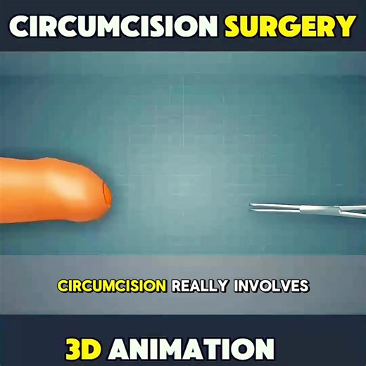 How ZSR Circumcision Surgery Eskin. Performed ? ( 3D Animation) #fyp #foryoupage #circumcision #3danimation