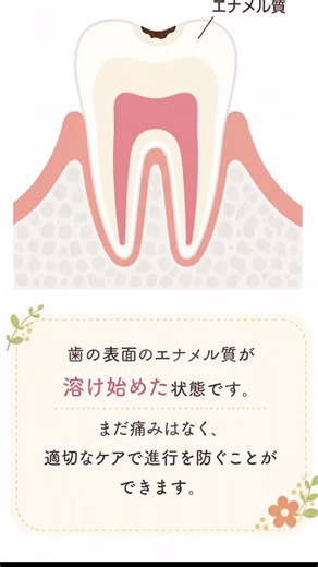 【むし歯】 - ̗̀‎𖤐 むし歯の進行の仕方 𖤐 ̖́-