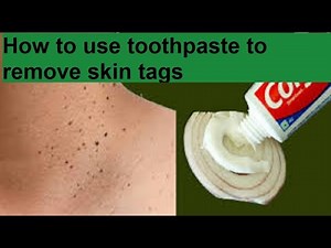 How to use toothpaste to remove skin tags