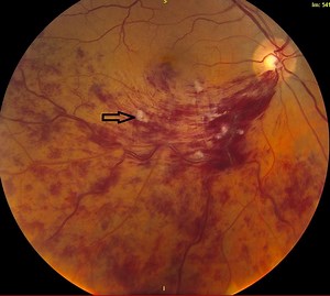 Retinal Vein Occlusions: Diagnosis and Management
