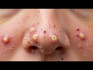 Loan Nguyen Acne Treatment 6ee