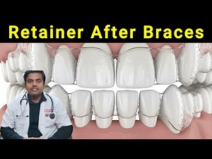 Braces Treatment Done? Don’t Forget the Most Important Step – RETAINERS