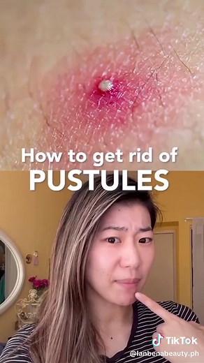 #lanbena #acne #pimple #acneremoval #skincare #fyp