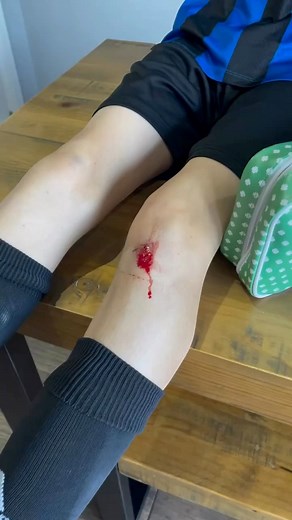 Do you have an active child who is forever getting scraped knees, blisters and bumps?! 💚 We want our kids to explore and play and be active and it’s a normal side-effect for scrapes and falls to happen. 💚 Our ‘Mini’ First Aid Kit and our larger Family First Aid Kit have all the basics you need to tend to minor injuries in a durable, stylish pouch that you can pop in your bag, under the buggy or in your glove box https://minifirstaidshop.co.uk/collections/first-aid-kits | Mini First Aid