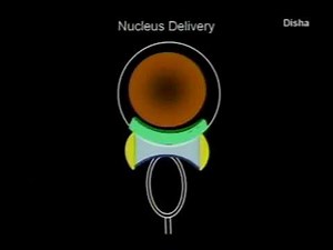 Instruction Course on SICS (MSICS) Dr.Debasish Bhattacharya | Disha Eye Hospitals