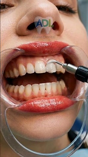 Tooth Restoration Transformation 😱 Deep Cavity Repair & Perfect Smile Makeover #shorts