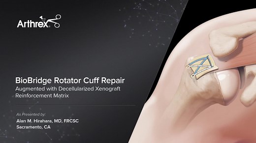 BioBridge® Rotator Cuff Repair Augmented with DX Reinforcement Matrix