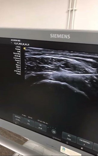 Infiltración de articulación del hombro