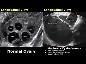 Gynecological Ultrasound Ovary Normal Vs Mucinous Cystadenoma | Benign Ovarian Cystic Neoplasms USG