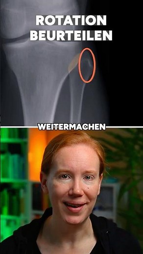 Knie a.p. rotiert oder nicht? Der Fibula-Check in 2 Sekunden | Röntgen-Anatomie Knie