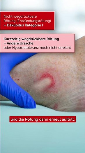 Fingertest nach Phillips - Dekubitus