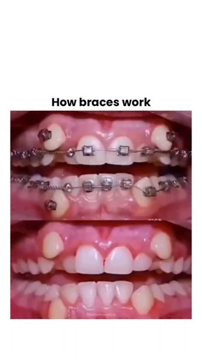 Theviralblendhub on Instagram: "Braces work by applying steady gentle pressure to the teeth over a long period of time, which gradually moves them into better alignment. The brackets are attached to the teeth and connected by a flexible wire that tries to return to its original shape, and as it does so it guides the teeth into new positions. This pressure causes the bone around the teeth to slowly break down and rebuild in a way that allows movement, while adjustments made by an orthodontist con