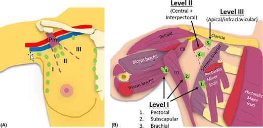 Sonographic localisation of lymph nodes suspicious of metastatic breast cancer to surgical axillary levels