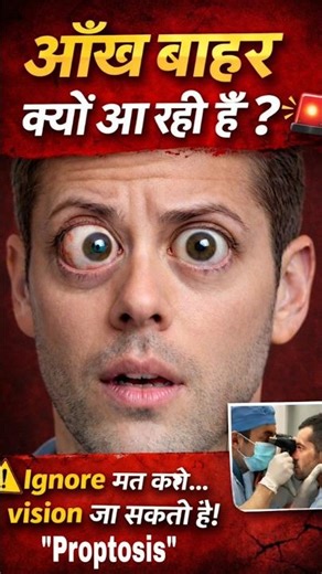 Proptosis explained in Hindi | “Aankh Bahar Kyun Nikal Rahi Hai? #Proptosis #eyes #Optometry #facts